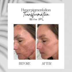 The Anti Aging Clinic of North West Florida - Before & After IPL