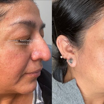 NovoBay Aesthetic Clinic - Medical Spas Near Me - Sunnyvale, California NovoBay Aesthetic Clinic - Medical Spas Near Me - Sunnyvale, California