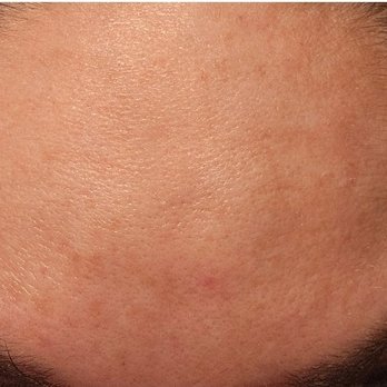 Lougheed Laser Centre - Spocked eyebrows by Lougheed laser clinic - Medical Spas Near Me - Burnaby, British Columbia Lougheed Laser Centre - Spocked eyebrows by Lougheed laser clinic - Medical Spas Near Me - Burnaby, British Columbia