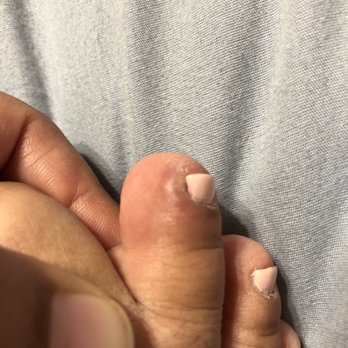 Q Nails - Super sensitive bump with what seems to be pus on the inside... - Nail Salons Near Me - Santa Ana, California