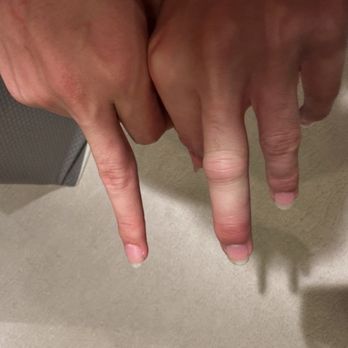 Reach Beyond Therapy - Broken finger - Occupational Therapy Near Me