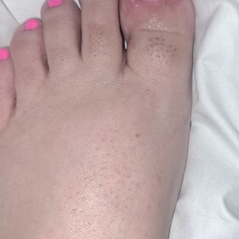 Rose Nails - My big toe is infected - Nail Salons Near Me - San Pedro, California Rose Nails - My big toe is infected - Nail Salons Near Me - San Pedro, California