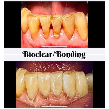 Richard R Walker,DDS - Bioclear to close black triangles with no tooth reduction and done in 1 hour. Patient had minimal out of pocket cost. - General Dentistry Near Me - Chehalis, Washington