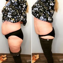Colorado Body Sculpting & Rejuvenation Center - Before and After one treatment