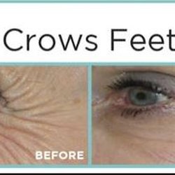Before and After Botox/Xeomin