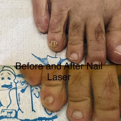 Michael R. Cook, Podiatry - Before and after nail laser treatments