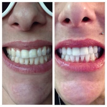 Ken Garcia DDS - Zoom whitening wearing temporary crowns - Endodontists Near Me - Laguna woods, California