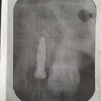 Regency Square Mall Dental - X-Ray done at Regency Square Mall Dental - of the wrong tooth, according to Dr. Ospina. - Pediatric Dentists Near Me - Jacksonville, Florida Regency Square Mall Dental - X-Ray done at Regency Square Mall Dental - of the wrong tooth, according to Dr. Ospina. - Pediatric Dentists Near Me - Jacksonville, Florida