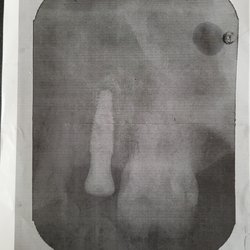 Regency Square Mall Dental - X-Ray done at Regency Square Mall Dental - of the wrong tooth, according to Dr. Ospina.