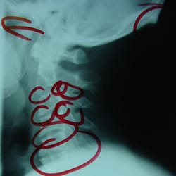 The Harte of Chiropractic - X-Rays...  We do them. Most chiropractors don't. Essential in analysis of Vertebral Subluxation Complex
