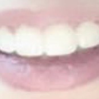 Braces Braces - Before treatment - Orthodontists Near Me - Mcdonough, Georgia