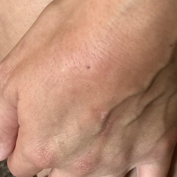 Hampton Inn La Junta - three bites on my hand - Hotels Near Me - La Junta, Colorado