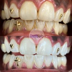 Teeth Whitening Lab  - Tea stains gone!
