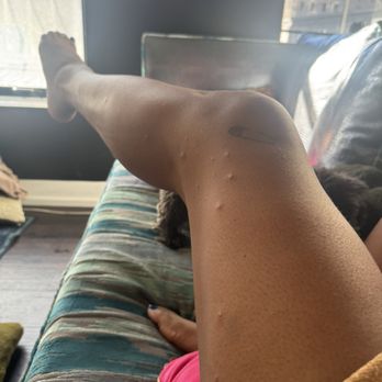 Moxy Miami South Beach - Bed bug bites - Hotels Near Me - Miami Beach, Florida