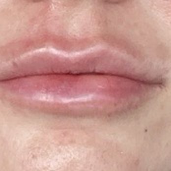 High Desert Dermatology - Right after Juvederm - Skin Care Near Me - Reno, Nevada