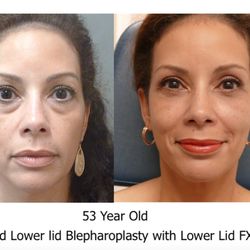 EltraSelf - Before and After Lower Lid Eyelid Surgery with FX Laser to Lower Lids