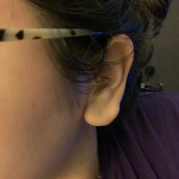 Dev Wali, MD Plastic Surgery-Medspa - Before - left ear - Cosmetic Surgeons Near Me - Claremont, California