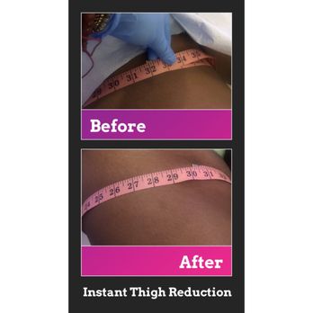 Beauteous Nyc - Cryotherapy Thigh Session - Skin Care Near Me - Yonkers, New York