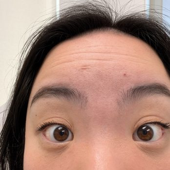 Biolite Wellness - Before forehead Botox - Weight Loss Centers Near Me - Irvine, California