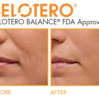 Elume MedSpa - Belotero- Dermal Filler - Skin Care Near Me - Fairfax, Virginia