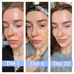 Hydration Plus Beauty - Microneedling with PRP progress