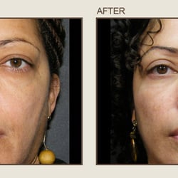 Center For Eye & Laser Surgery - Before & After
Center for Eye & Laser Surgery- Severna Park, Maryland