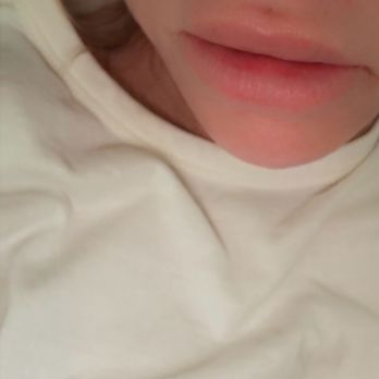 Beauty By The Bay - Luscious lipslol - Medical Spas Near Me - Burlingame, California Beauty By The Bay - Luscious lipslol - Medical Spas Near Me - Burlingame, California