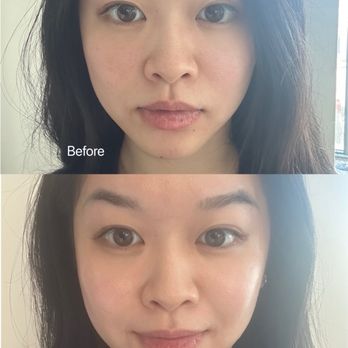 Dawoom Clinic - Before/after comparison for SONO+Hifu treatment - Medical Spas Near Me - Los Angeles, California Dawoom Clinic - Before/after comparison for SONO+Hifu treatment - Medical Spas Near Me - Los Angeles, California