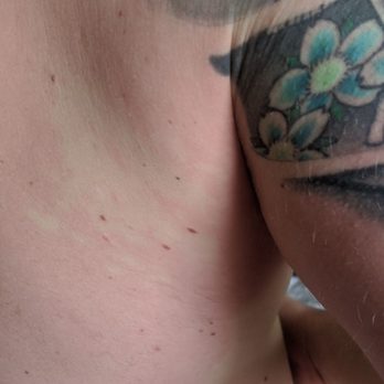 Trifecta - Red splotchy rash all over side/back. - Food Delivery Services Near Me - Sacramento, California Trifecta - Red splotchy rash all over side/back. - Food Delivery Services Near Me - Sacramento, California
