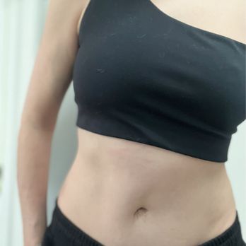 Le Beauty Concierge Body Contour - 2yrs post op - Body Contouring Near Me - Houston, Texas Le Beauty Concierge Body Contour - 2yrs post op - Body Contouring Near Me - Houston, Texas