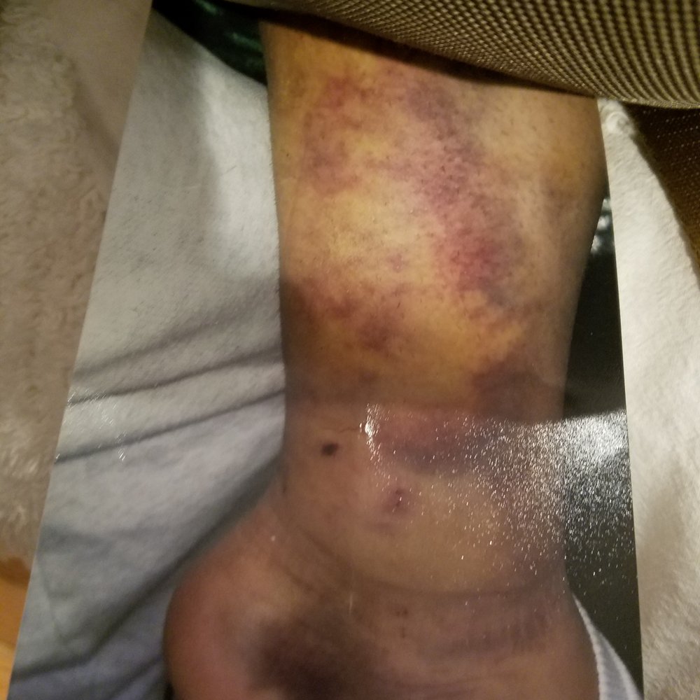 Gulotta & Gulotta - Thanks for making us wait 7 years for 7,500.00 dollars, we even got to pay for our own medical bill's after you guys sent me for 5 opinions. - Personal Injury Law Near Me - Ronkonkoma, New York Gulotta & Gulotta - Thanks for making us wait 7 years for 7,500.00 dollars, we even got to pay for our own medical bill's after you guys sent me for 5 opinions. - Personal Injury Law Near Me - Ronkonkoma, New York