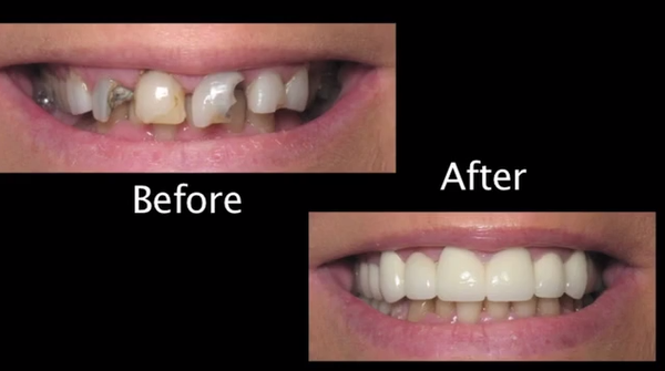 Beach Teeth by null
