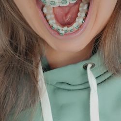 Southern Nevada Orthodontics - Day 1 of braces