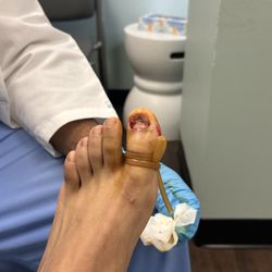 Ankle & Foot Care Center - Damaged nail removal