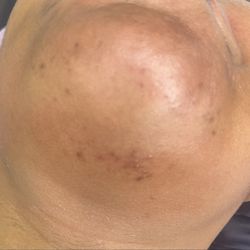 Glo’Honey Aesthetics - Chin wax (After)