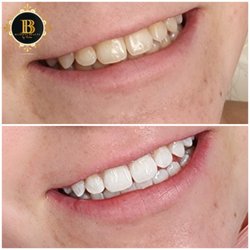 Teeth whitening