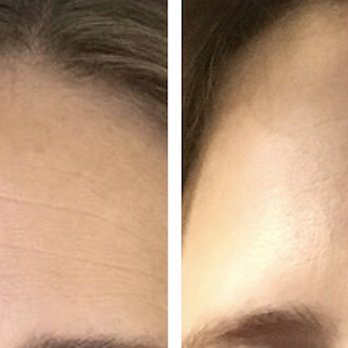 SkinDesigner Clinic - Botox treatment. Wrinkle free. - Medical Spas Near Me - Caldwell, New Jersey SkinDesigner Clinic - Botox treatment. Wrinkle free. - Medical Spas Near Me - Caldwell, New Jersey