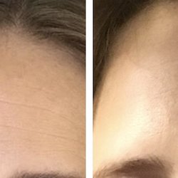 SkinDesigner Clinic - Botox treatment. Wrinkle free.