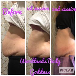 Woodlands Body Goddess - Fire and Ice!! Fat reduction