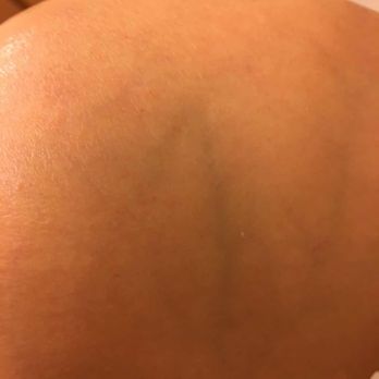 DAO Acupuncture Clinic - After treatment picture- recovered sooner than I expected! - Acupuncture Near Me - Arcadia, California DAO Acupuncture Clinic - After treatment picture- recovered sooner than I expected! - Acupuncture Near Me - Arcadia, California