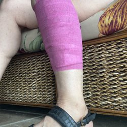 Kaloko Urgent Care - All cleaned up. Bandaged for three days, once scabbed was able to go in the ocean, pool etc.