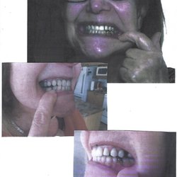 Centre Dentaire Pierre Deslauriers - les dents du haut n'ont aucun contact avec les dents du partiel