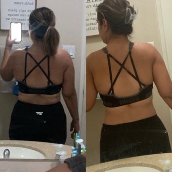 Body Shape Glendora - One week difference with two rolls. What back fat - Body Contouring Near Me - Glendora, California