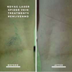 Enliven MD Skin and Laser - Spider vein treatments with Fotona NdYAG laser means no needles and no post-op hyperpigmentation #enlivenmd #theskincritics