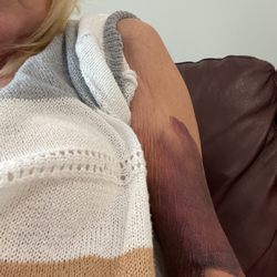 Atmed Treatment Center - Bruising due to lifting a heavy object