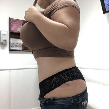 BGMG Cosmetics - 12 weeks post op Side - Cosmetic Surgeons Near Me - Bell Gardens, California BGMG Cosmetics - 12 weeks post op Side - Cosmetic Surgeons Near Me - Bell Gardens, California