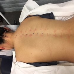Yong Jun Lu, Lac - Treating my upper and lower back pain!