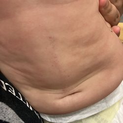 Bryan Medical Center West Campus - Bruise on daughters belly