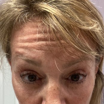 Florida Coastal Plastic Surgery - 4 weeks after my last injections & I have as much movement as before any treatments - Plastic Surgeons Near Me - Bradenton, Florida