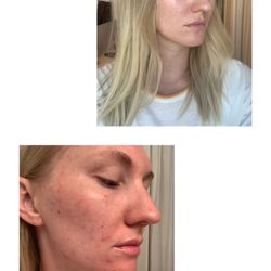 Skintherapy Skincare & Acne Clinic - Results after 5 months. No makeup or filters.